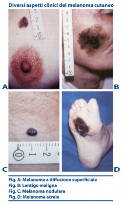 melanoma_diagnosi Diagnosi melanoma