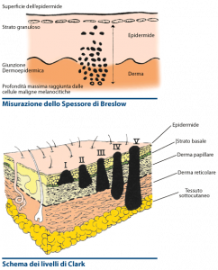 Diagnosi melanoma